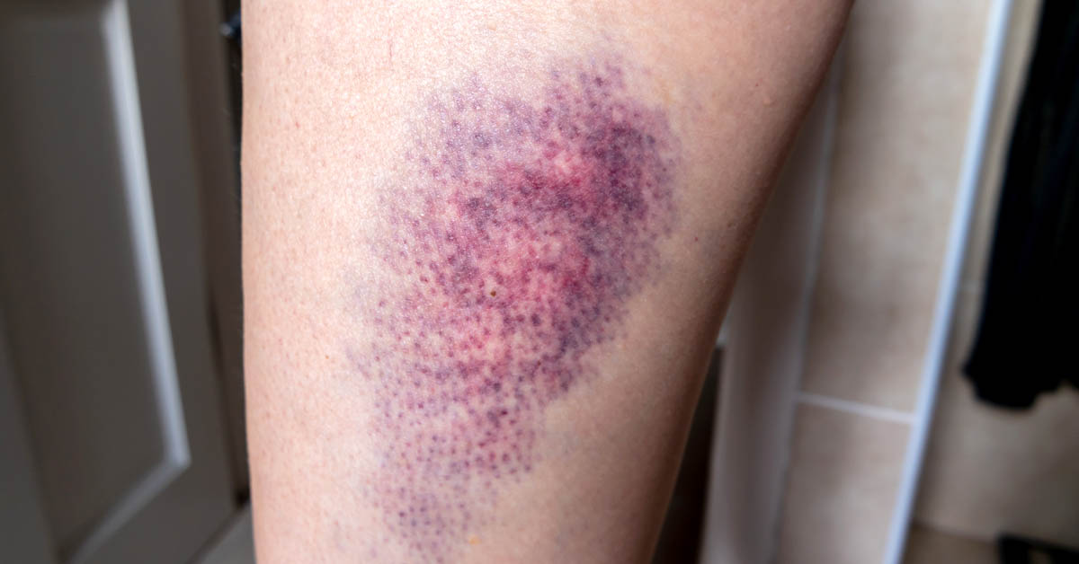 Treat a Bruise at Home - Personal Injury Attorney